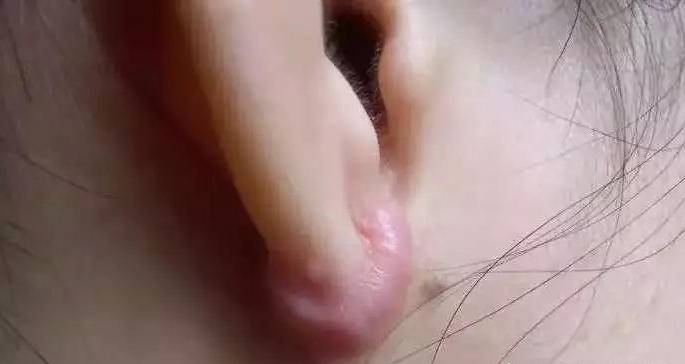 打耳洞感染事件,打耳洞造成颅内感染