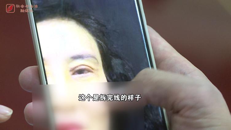 太原华美医疗美容医院双眼皮,太原华美医疗美容医院割双眼皮