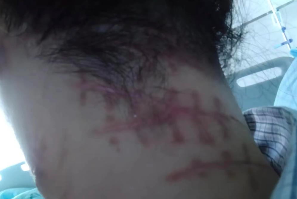 女子遭入室抢劫中十多刀装死,女子遭入室抢劫身中十多刀