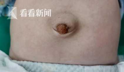 婴儿脐疝的特点及治疗护理措施