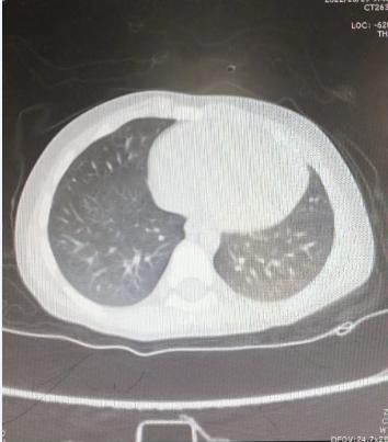 省立三院儿童支气管肺炎,儿童大叶性肺炎纤维支气管镜治疗