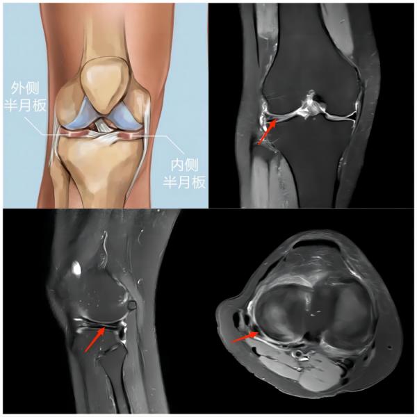 运动损伤知识科普宣传内容,关于足球运动损伤调查问卷
