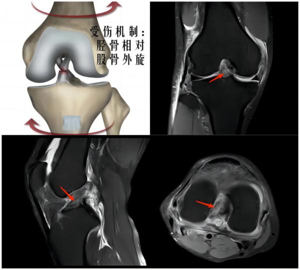 运动损伤知识科普宣传内容,关于足球运动损伤调查问卷