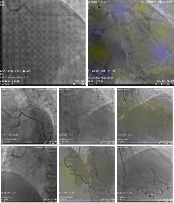 3DF打印助力温州医科大温州医科大学附属第一医院周浩团队完成一例复杂高危的冠脉CTO手术